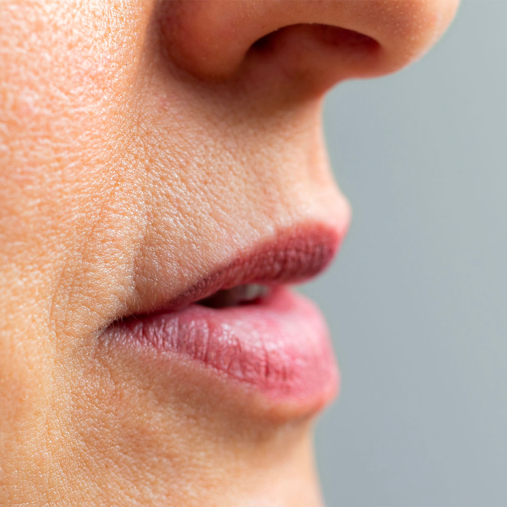 rides du fumeur bouche injections acide hyaluronique