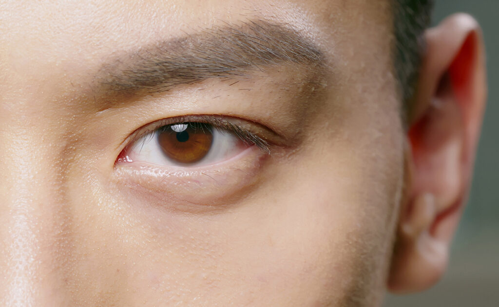 injection homme acide hyaluronique cernes