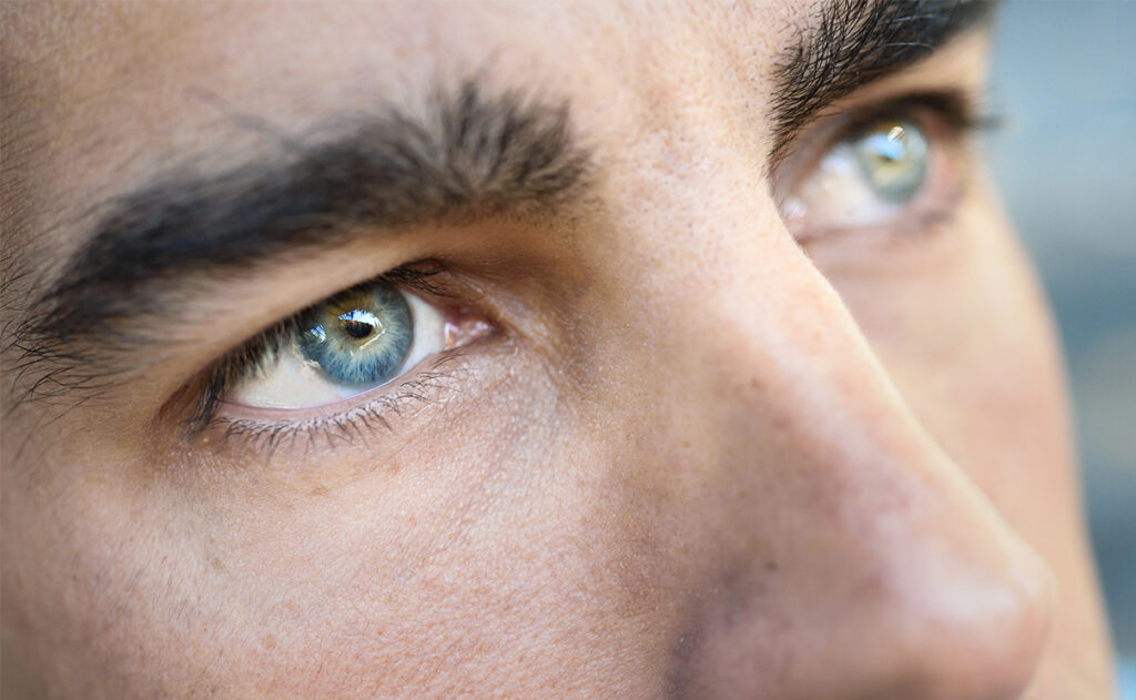 injection toxine botulique homme pattes d'oie