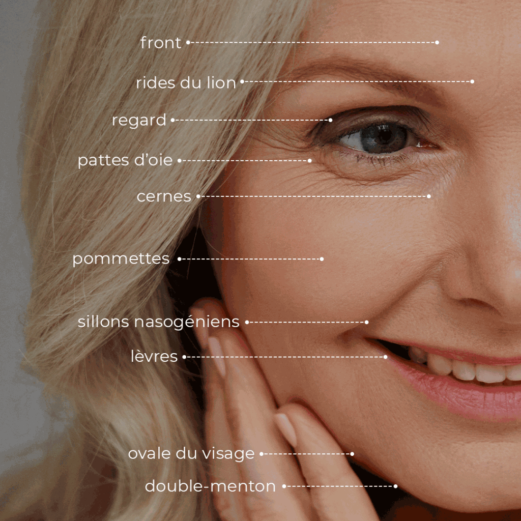 zones injectables visage